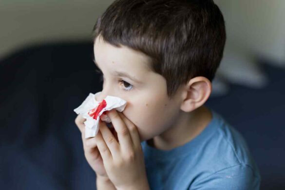 covid nose bleed
